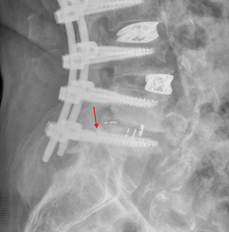 Gebrochene Pedikelschraube Röntgen