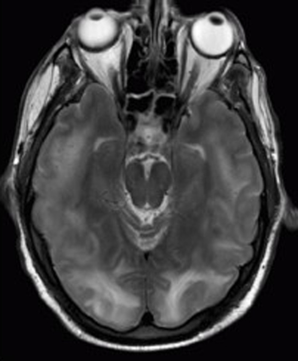PRES Syndrom MRT
