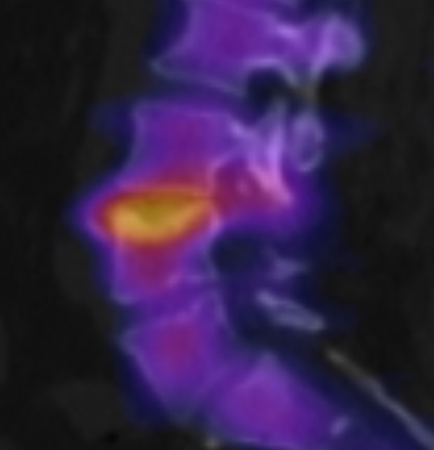 SPECT/CT Schmorl Knoten