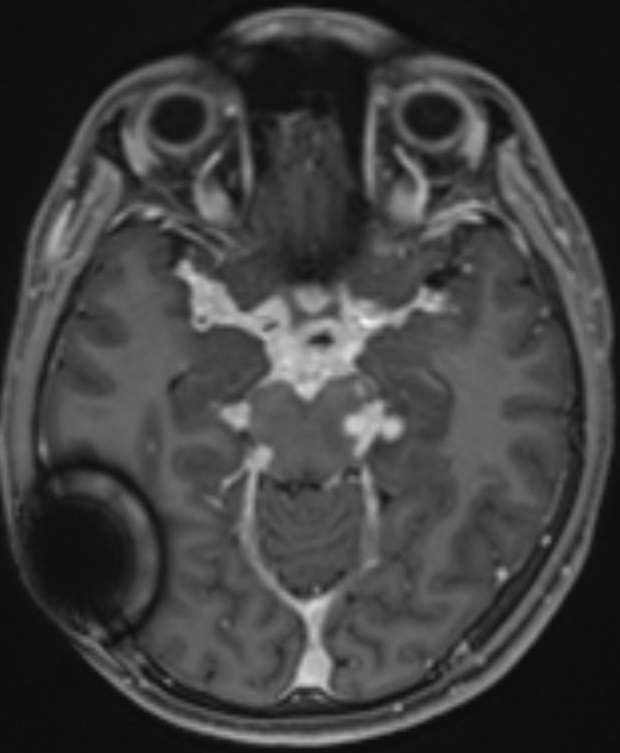 MRI of tuberculous meningitis