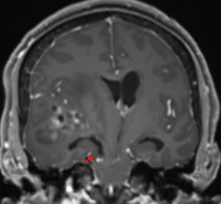 Uncale Einklemmung MRT