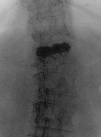Vertebroplastie LWK1