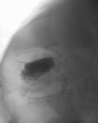 Vertebroplastie Röntgen