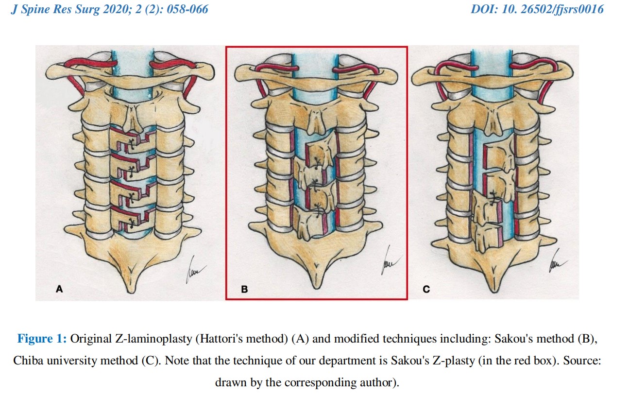 Z-Laminoplasty