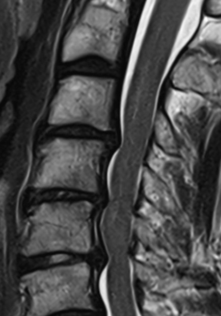 Zervikale Spinalkanalstenose MRT