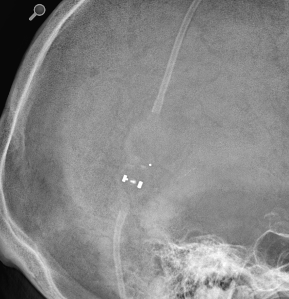 Codman Certas Plus Shuntsystem Ars Neurochirurgica