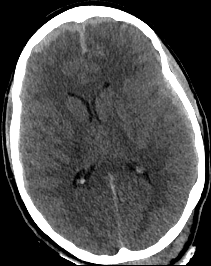 Schädelhirntrauma im CT
