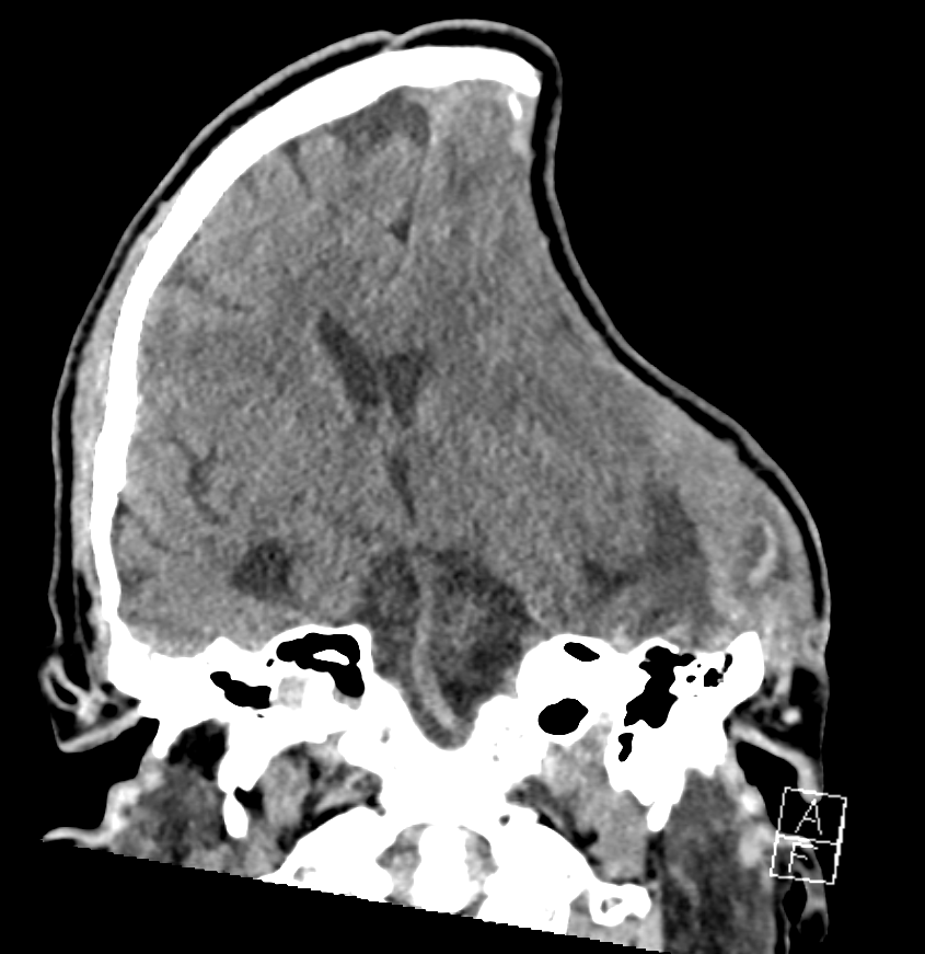 CT Bild eines Patienten mit Sinking skin flap Syndrom