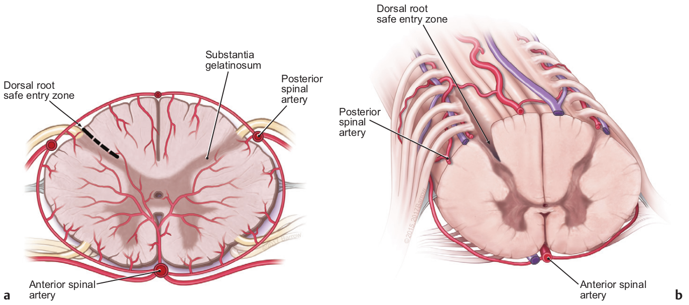 Safe Entry Zone Dorsal Root