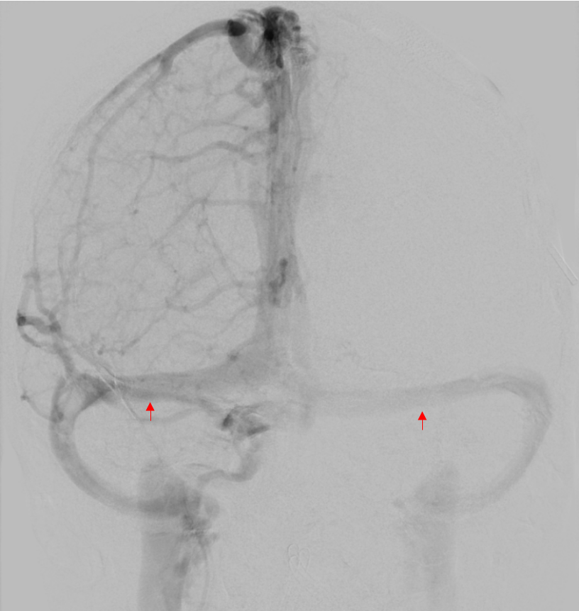 Sinus transversus Angiographie