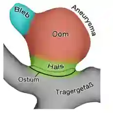 Aufbau eines Aneurysma