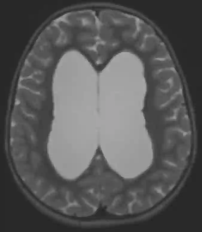 MRI eines Hydrocephalus