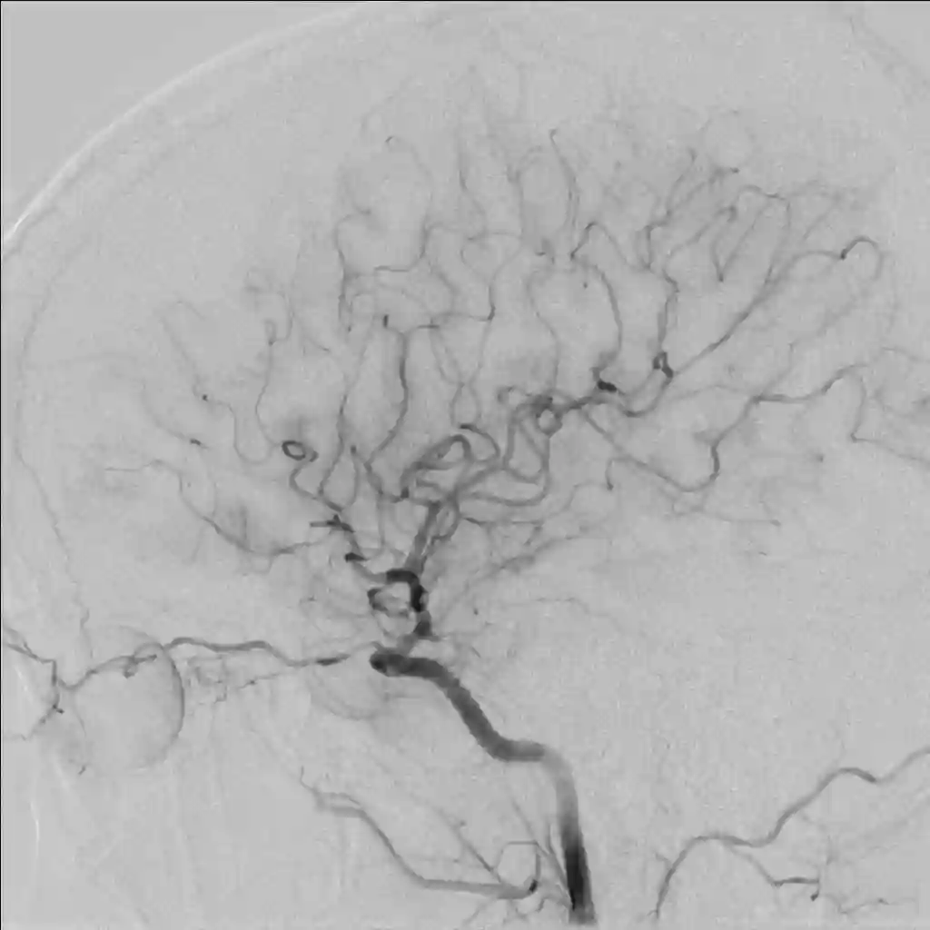 Digitale Subtraktionsangiographie