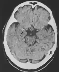 Hyperdense middle cerebral artery sign im CT