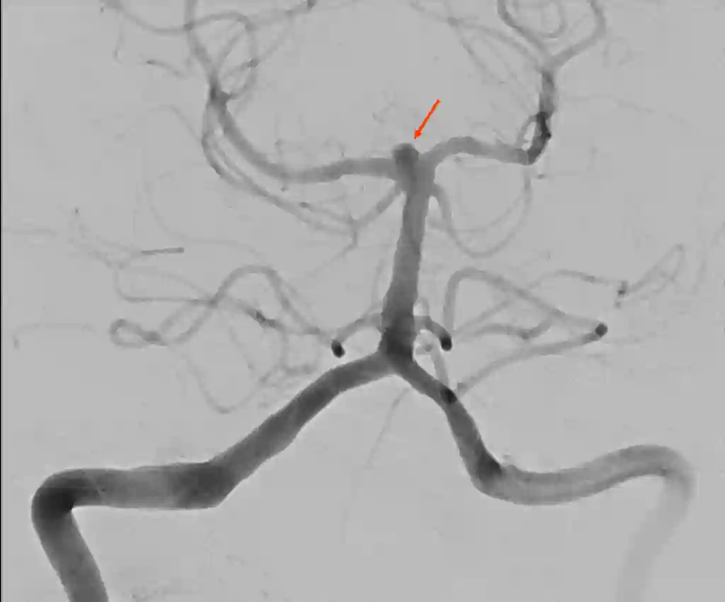Basilarisspitzenaneurysma