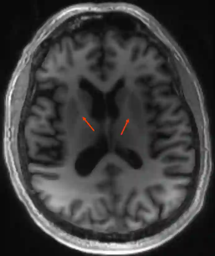 Capsula interna MRI MDEFT Sequenz