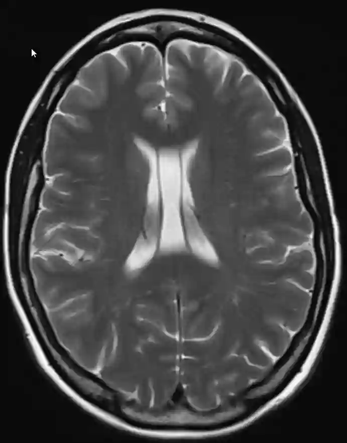 Cavum septi pellucidi mit Cavum vergae