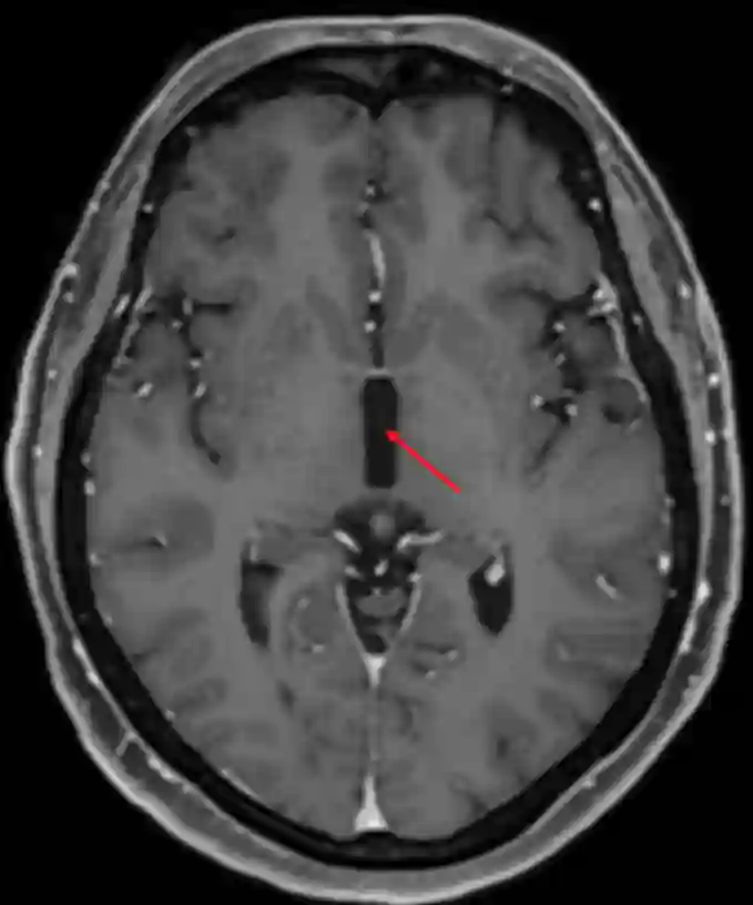 Dritter Ventrikel im axialen MRI