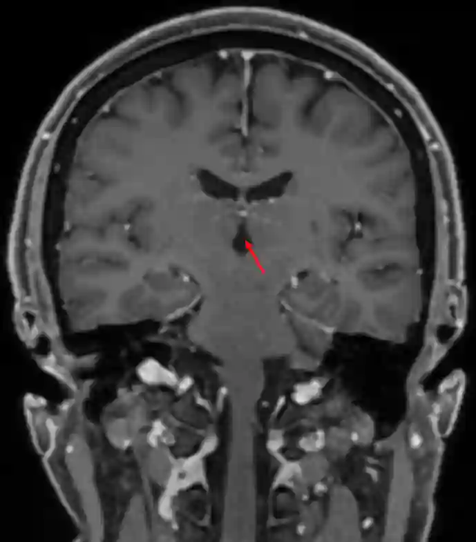 Dritter Ventrikel im MRI
