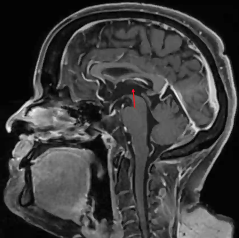 Dritter Ventrikel im MRI