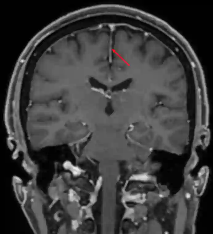 Falx cerebri im MRI
