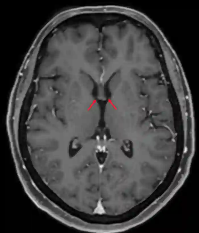 Foramen Monroi im axialen MRI