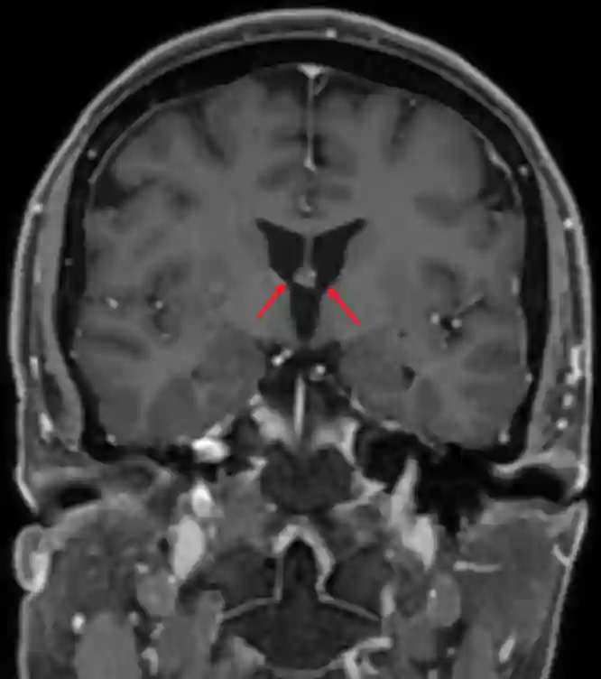 Foramen Monroi im MRI