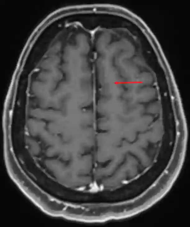 Gyrus frontalis superior im MRI