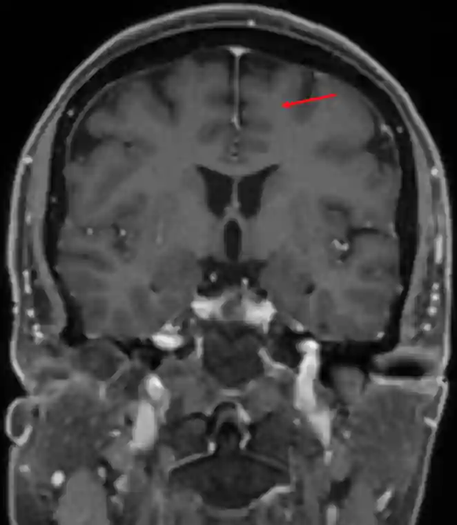 Gyrus frontalis superior im MRI.