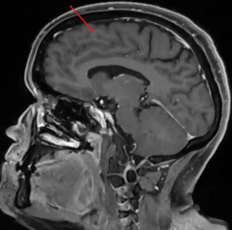 Gyrus frontalis superior im sagittalen MRI.