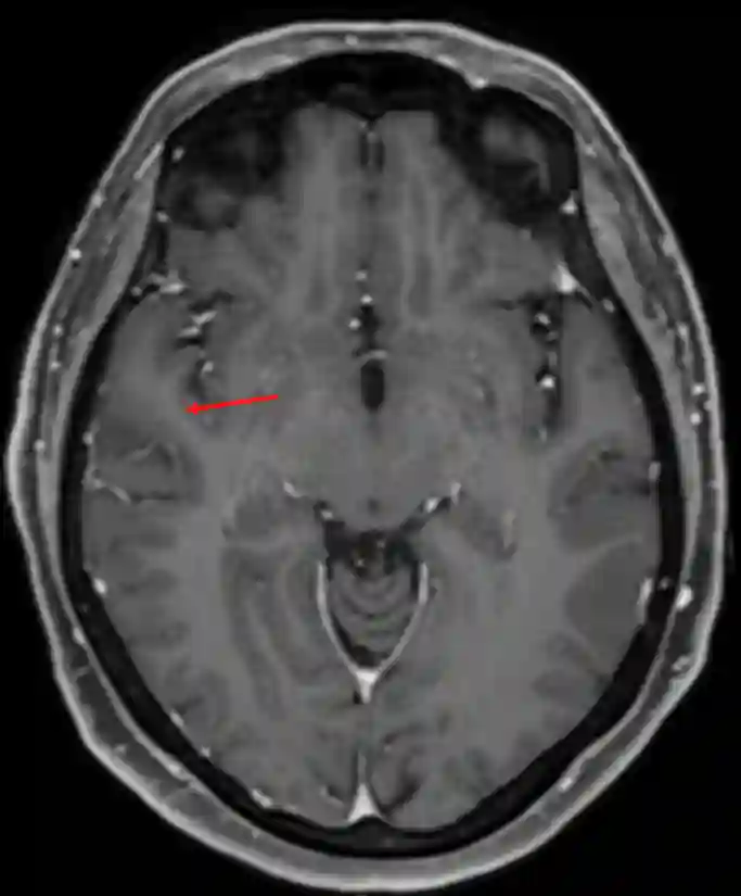 Gyrus temporalis superior im MRI.