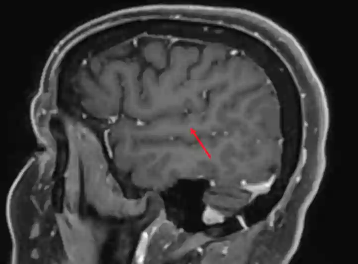 Gyrus temporalis superior im MRI
