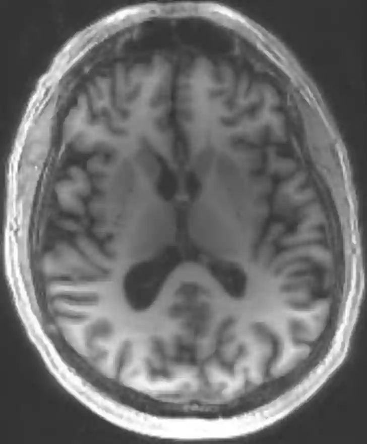 Axiale MRI MDEFT Sequenz