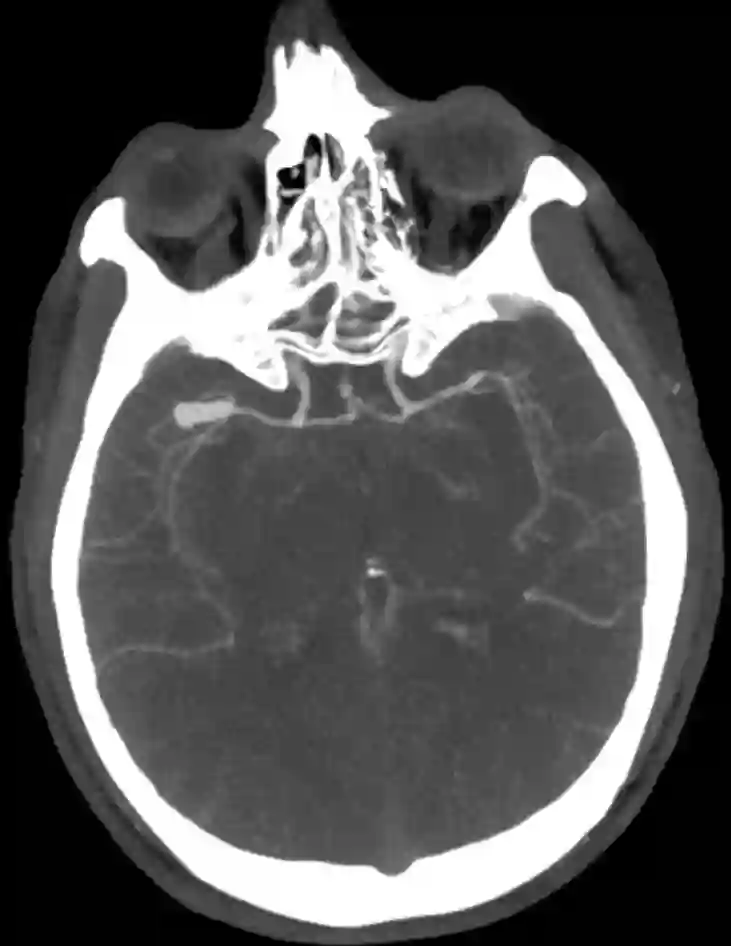 Mediabifurkationsaneurysma CT Angiographie