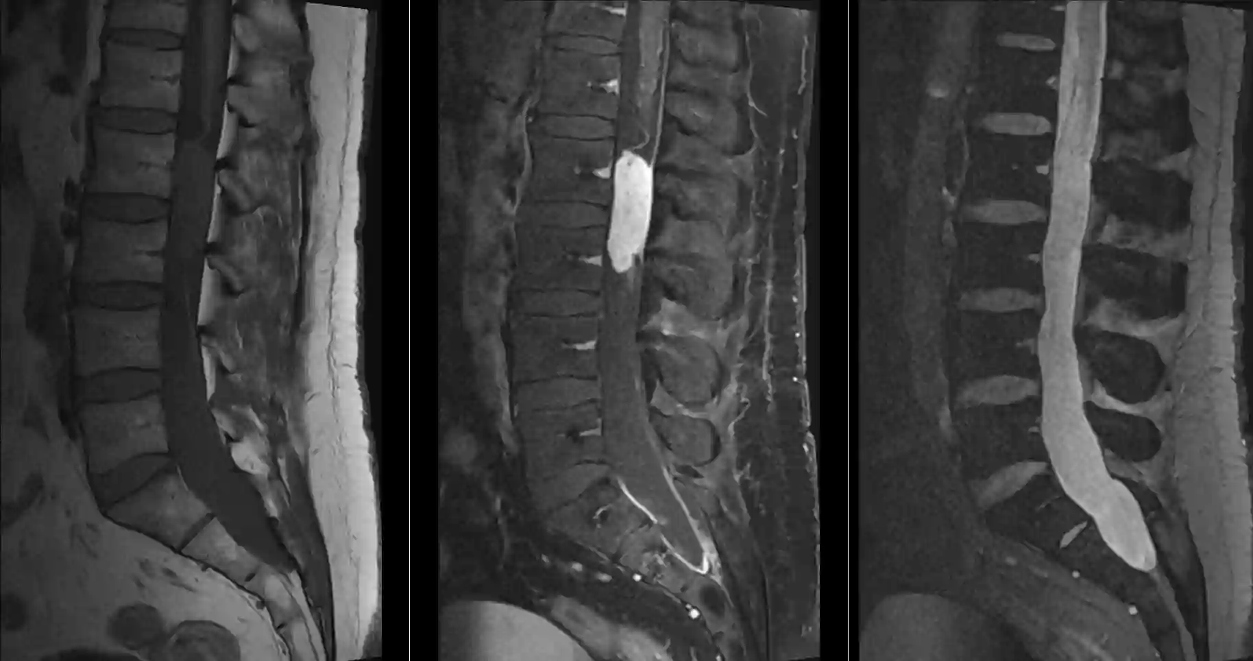 Myxopapilläres Ependymom im MRI