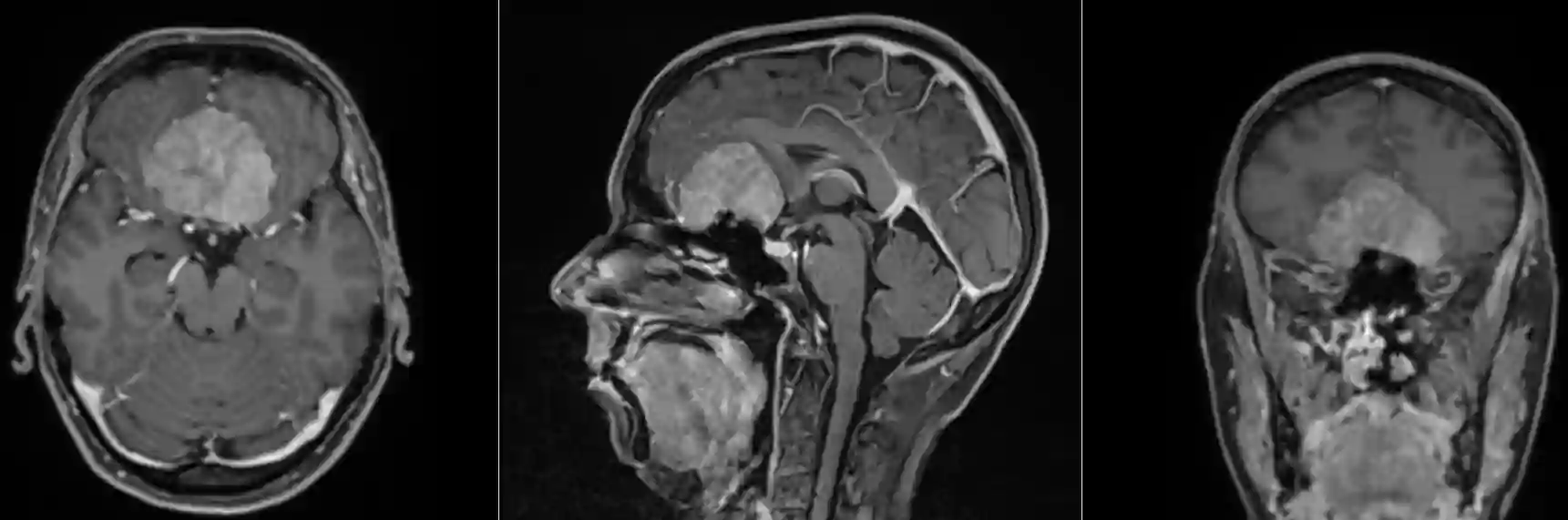 Planum sphenoidale Meningeom MRI