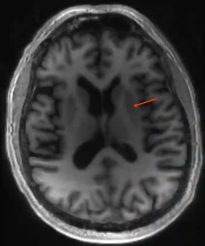 Putamen im MRI MDEFT Sequenz