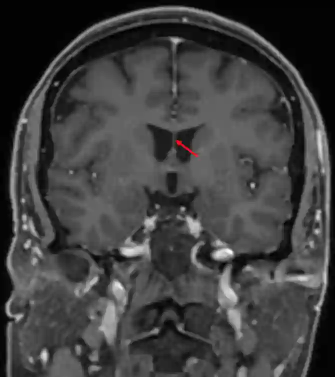 Septum pellucidum im MRI