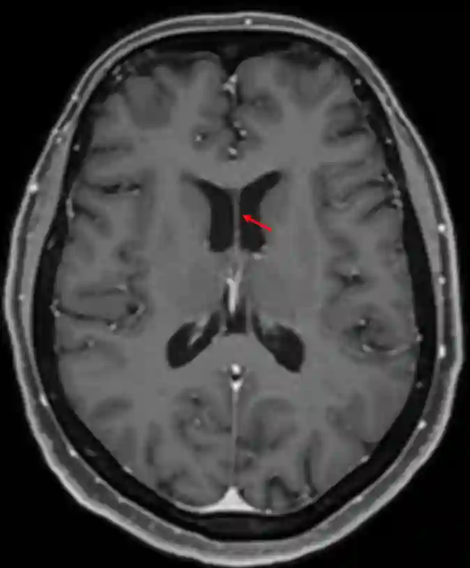 Septum pellucidum im MRI