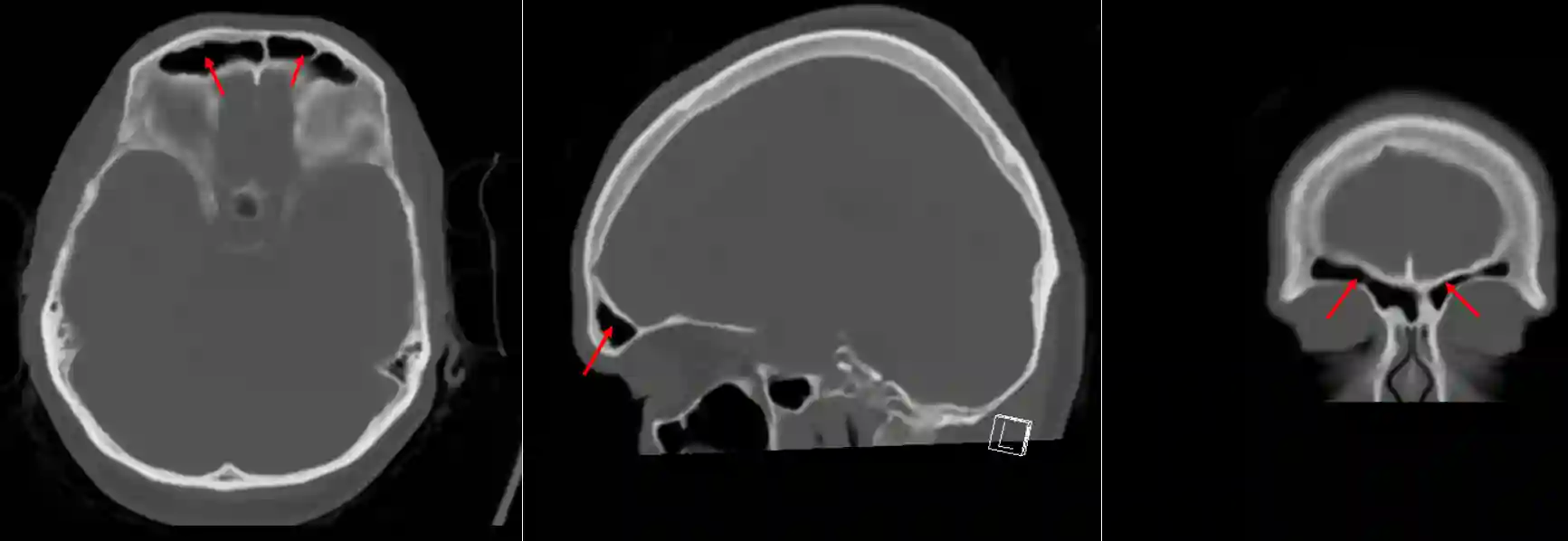 Sinus frontalis im CT