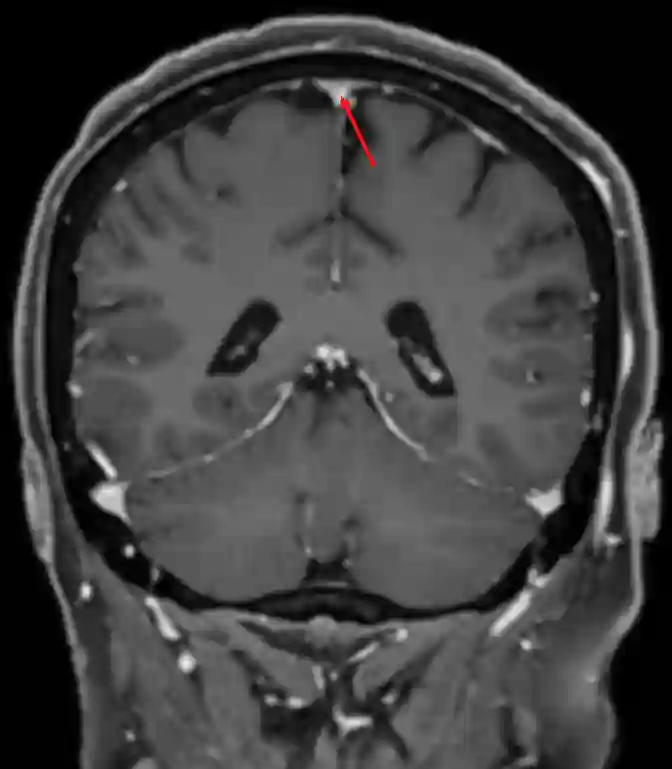 Sinus sagittalis superior im MRI.