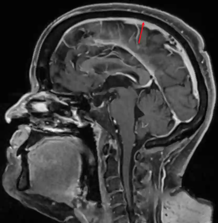 Sinus sagittalis superior im MRT