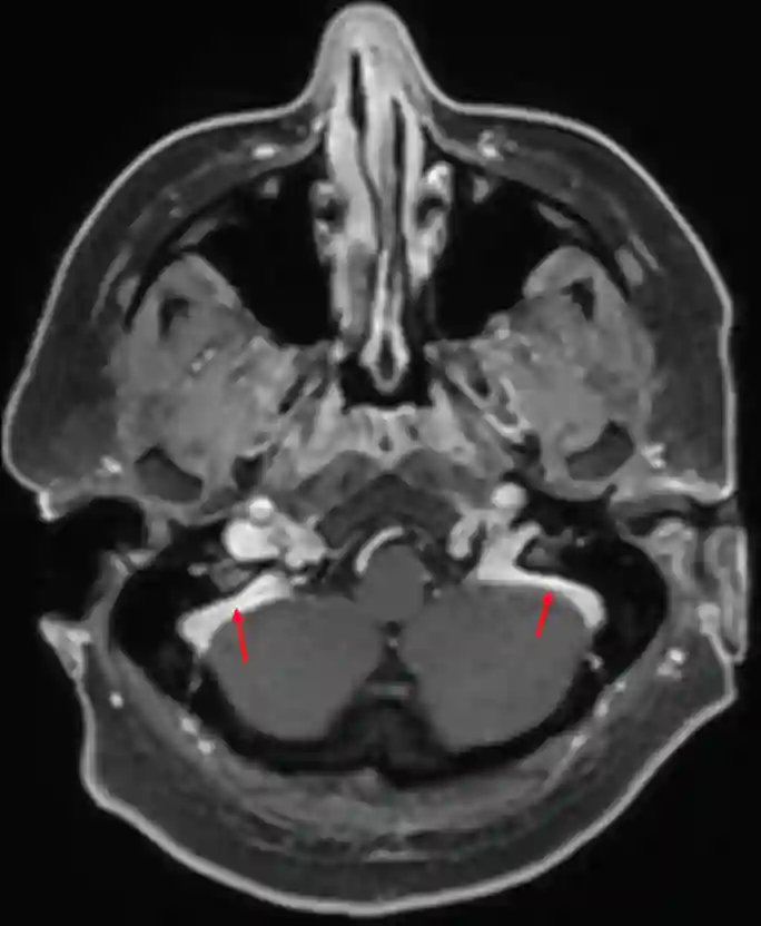 Sinus sigmoideus im MRI