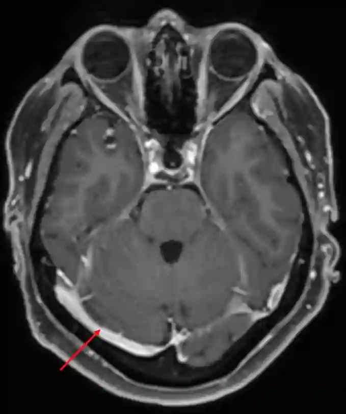 Sinus transversus im MRI