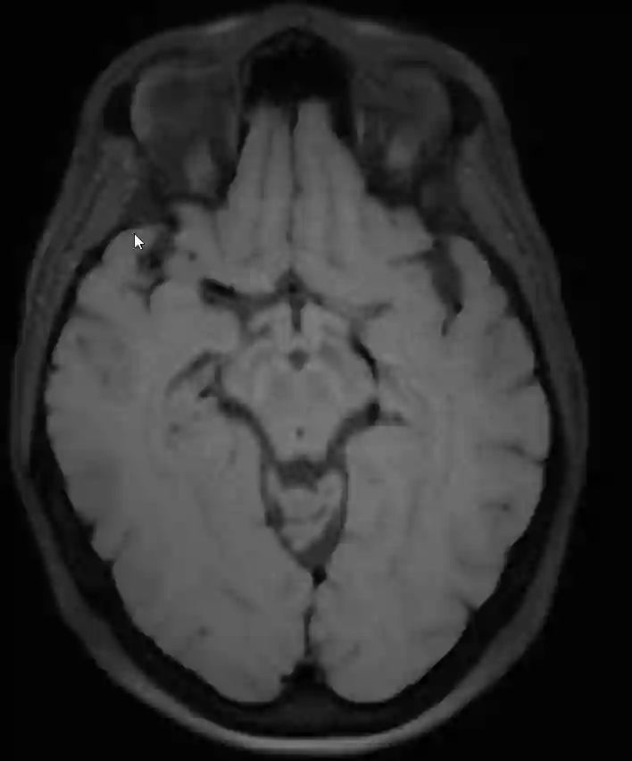 Mesencephalon MRI
