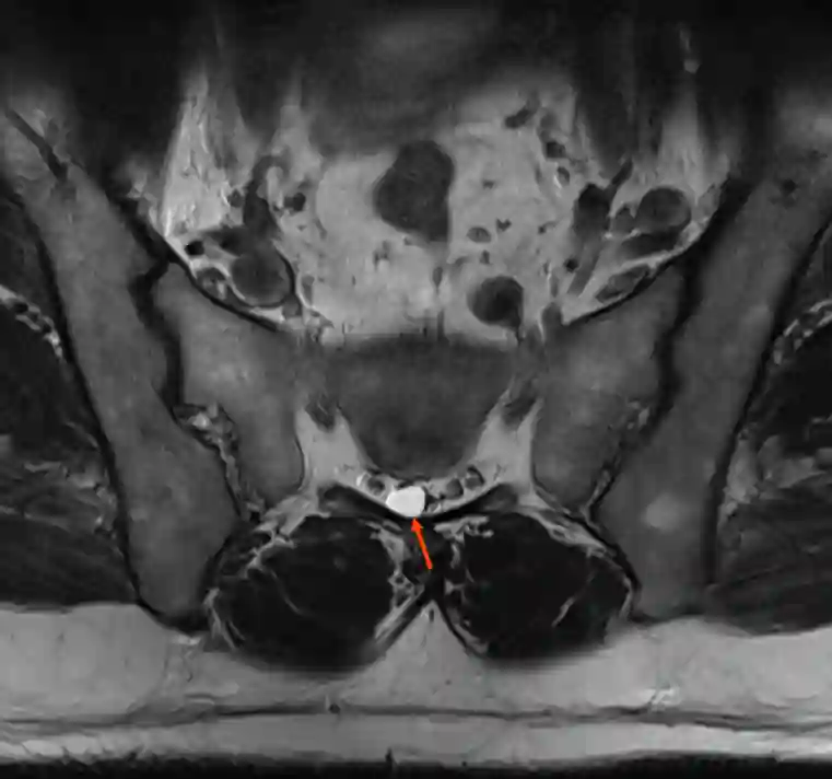 Tarlov Zyste im MRI