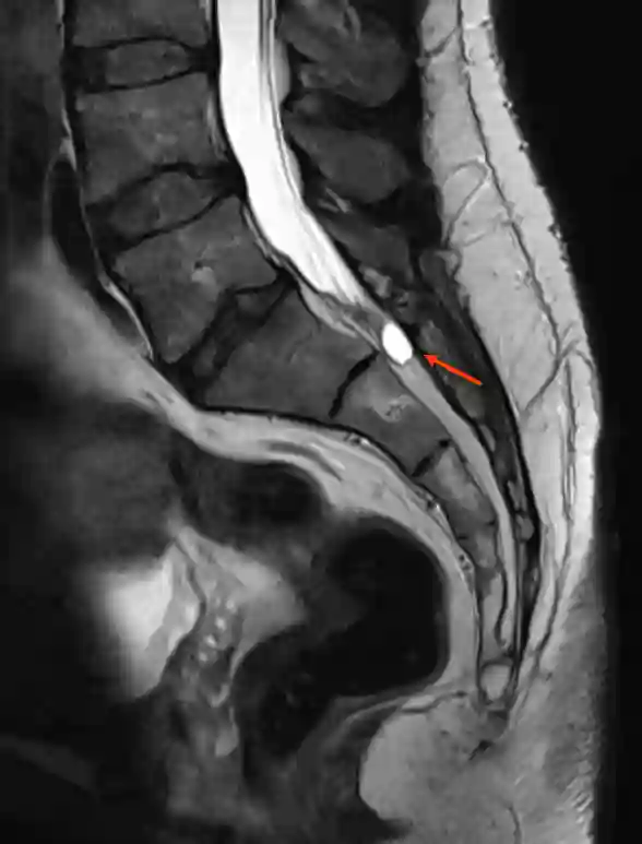 Tarlov Zyste T2 Sagittal MRT