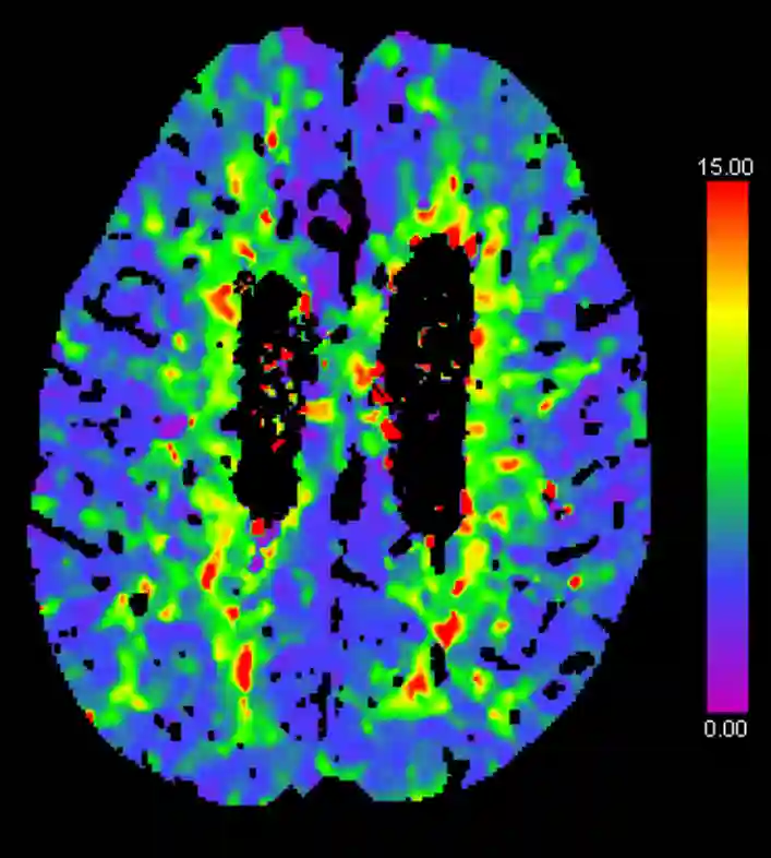 TTD CT Perfusion