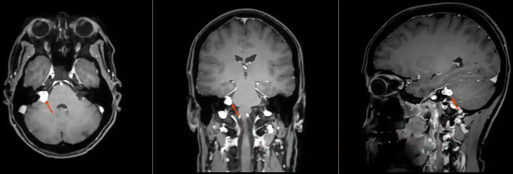 MRI Vestibularisschwannom