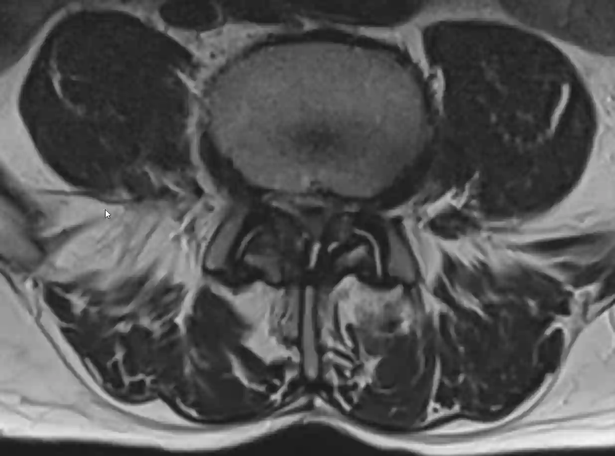 Absolute Spinalkanalstenose im MRI